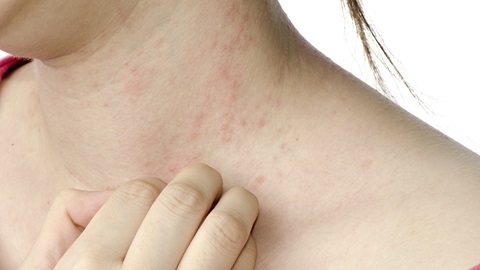 psoriasis-als-de-huid-op-hol-slaat